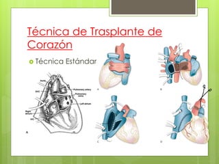 Técnica de Trasplante de
Corazón
 Técnica Estándar
 