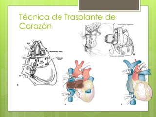 Técnica de Trasplante de
Corazón
 Técnica Bicava
 