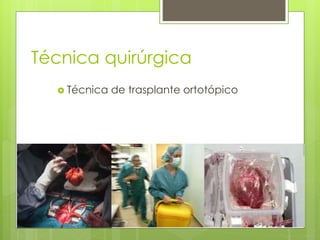 Técnica quirúrgica
 Técnica de trasplante ortotópico
 