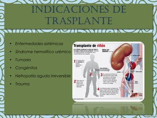 • Enfermedades sistémicas
• Síndrome hemolítico urémico
• Tumores
• Congénitos
• Nefropatía aguda irreversible
• Trauma
IndIcacIones de
trasplante
 