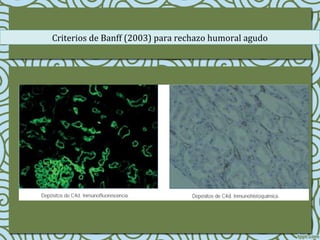 Criterios de Banff (2003) para rechazo humoral agudo
 