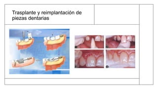 Trasplante y reimplantación de
piezas dentarias
 