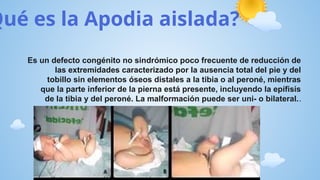 Trastorno de crecimiento de extremidades y.pptx