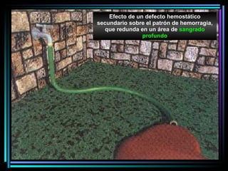 E fec to de un  defect o  hemostá tico  secu ndario  sobre el patrón de hemorr agia , que redund a  en un  á rea de  sa n gra do  profun do 