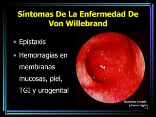 Síntomas De La Enfermedad De Von Willebrand Epistaxis  Hemorragias en membranas mucosas, piel, TGI y urogenital Duodeno irritado  y hemorrágico 