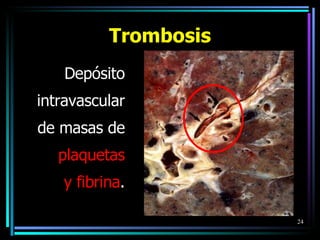 Trombosis Depósito intravascular de masas de plaquetas y fibrina . 
