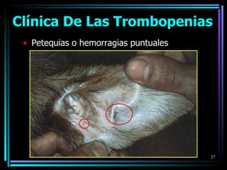 Clínica De Las Trombopenias Petequias o hemorragias puntuales 