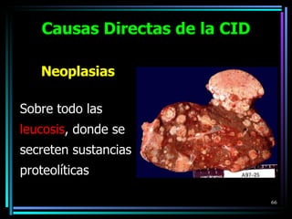 Neoplasias Sobre todo las leucosis , donde se secreten sustancias proteolíticas Causas Directas de la CID 