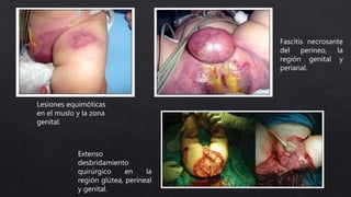Lesiones equimóticas
en el muslo y la zona
genital.
Fascitis necrosante
del perineo, la
región genital y
perianal.
Extenso
desbridamiento
quirúrgico en la
región glútea, perineal
y genital.
 