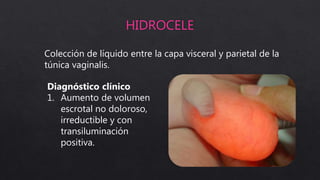Colección de líquido entre la capa visceral y parietal de la
túnica vaginalis.
Diagnóstico clínico
1. Aumento de volumen
escrotal no doloroso,
irreductible y con
transiluminación
positiva.
 