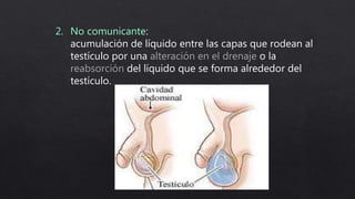 2. No comunicante:
acumulación de líquido entre las capas que rodean al
testículo por una alteración en el drenaje o la
reabsorción del líquido que se forma alrededor del
testículo.
 