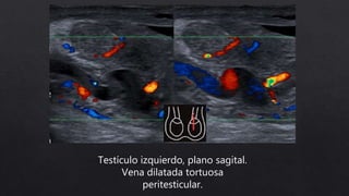 Testículo izquierdo, plano sagital.
Vena dilatada tortuosa
peritesticular.
 