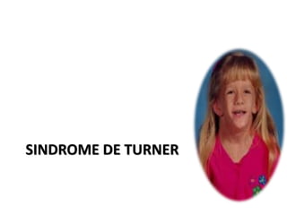SINDROME DE TURNER
 