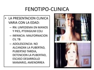 FENOTIPO-CLINICA
• LA PRESENTACION CLINICA
VARIA CON LA EDAD:
– RN: LINFEDEMA EN MANOS
Y PIES, PTERIGIUM COLI
– INFANCIA: MALFORNACION
CV, TB
– ADOLESCENCIA: NO
ALCANZAN LA PUBERTAD,
PUBERTAD TARDIA,
DETENCION LA PUBERTAD,
ESCASO DESARROLLO
MAMARIO, AMENORREA
 