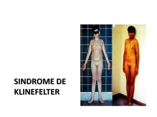 SINDROME DE
KLINEFELTER
 
