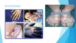 Acrocianosis 
 