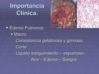  Edema Pulmonar:
 Macro:
Consistencia gelatinosa y gomosa.
Corte:
Liquido sanguinolento – espumoso.
Aire – Edema – Sangre.
Importancia
Clínica.
 