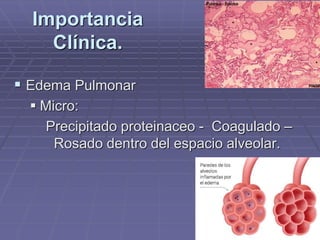  Edema Pulmonar
 Micro:
Precipitado proteinaceo - Coagulado –
Rosado dentro del espacio alveolar.
Importancia
Clínica.
 