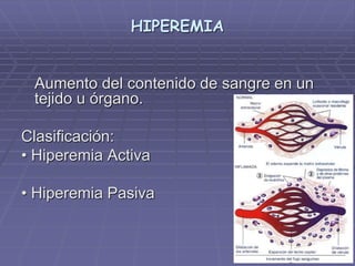 HIPEREMIA
Aumento del contenido de sangre en un
tejido u órgano.
Clasificación:
• Hiperemia Activa
• Hiperemia Pasiva
 
