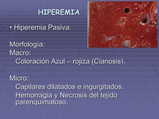 HIPEREMIA
• Hiperemia Pasiva:
Morfología:
Macro:
Coloración Azul – rojiza (Cianosis).
Micro:
Capilares dilatados e ingurgitados.
Hemorragia y Necrosis del tejido
parenquimatoso.
 