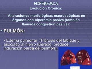 HIPEREMIA
Evolución Crónica:
Alteraciones morfológicas macroscópicas en
órganos con hiperemia pasiva (también
llamada congestión pasiva):
 PULMÓN:
• Edema pulmonar (Fibrosis del tabique y
asociado al hierro liberado, produce
induración parda del pulmón).
 