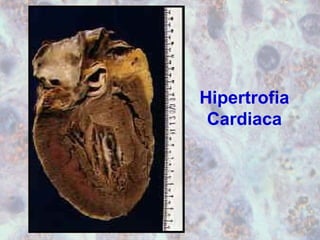 Hipertrofia 
Cardiaca 
 