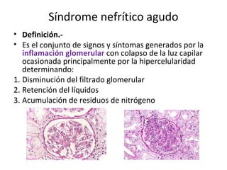 Síndrome nefrítico agudo
• Definición.-
• Es el conjunto de signos y síntomas generados por la
inflamación glomerular con colapso de la luz capilar
ocasionada principalmente por la hipercelularidad
determinando:
1. Disminución del filtrado glomerular
2. Retención del líquidos
3. Acumulación de residuos de nitrógeno
 