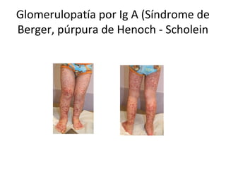 Glomerulopatía por Ig A (Síndrome de
Berger, púrpura de Henoch - Scholein
 