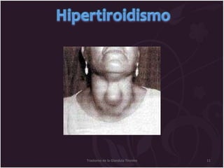 Trastorno de la Glandula Tiroides 