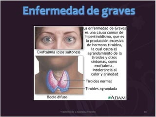 Trastorno de la Glandula Tiroides 