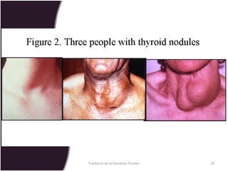 Trastorno de la Glandula Tiroides 