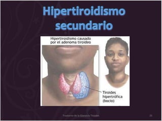 Trastorno de la Glandula Tiroides 