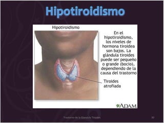 Trastorno de la Glandula Tiroides 
