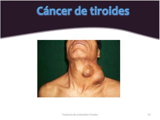 Trastorno de la Glandula Tiroides 