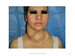 Trastorno de la Glandula Tiroides 