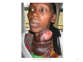 Trastorno de la Glandula Tiroides 