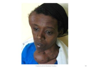 Trastorno de la Glandula Tiroides 