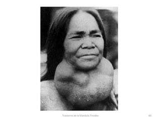 Trastorno de la Glandula Tiroides 