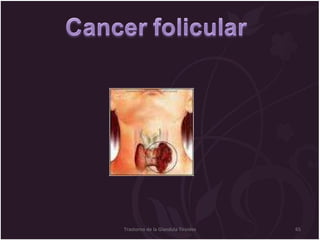 Trastorno de la Glandula Tiroides 