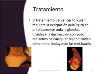 Tratamiento  El tratamiento del cáncer folicular requiere la extirpación quirúrgica de prácticamente toda la glándula tiroides y la destrucción con yodo radiactivo de cualquier tejido tiroideo remanente, incluyendo las metástasis.  Trastorno de la Glandula Tiroides 