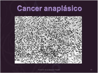 Trastorno de la Glandula Tiroides 