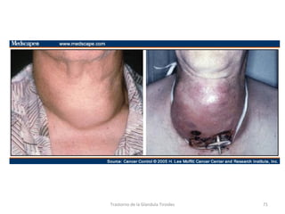 Trastorno de la Glandula Tiroides 