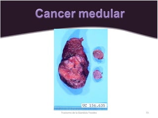 Trastorno de la Glandula Tiroides 