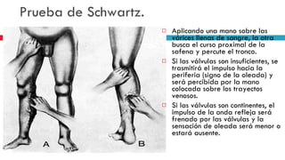 Prueba de Schwartz. Aplicando una mano sobre las várices llenas de sangre, la otra busca el curso proximal de la safena y percute el tronco.  Si las válvulas son insuficientes, se trasmitirá el impulso hacia la periferia (signo de la oleada) y será percibida por la mano colocada sobre los trayectos venosos.  Si las válvulas son continentes, el impulso de la onda refleja será frenado por las válvulas y la sensación de oleada será menor o estará ausente. 