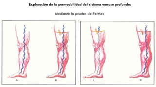 Exploración de la permeabilidad del sistema venoso profundo: Mediante la prueba de Perthes  