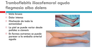 Tromboflebitis iliacofemoral aguda flegmasia alba dolens Inicio brusco Dolor intenso Hinchaz ó n de toda la extremidad La piel se puede variar desde palidez a cianosis En formas extremas se puede parecer a la embolia arterial aguda 