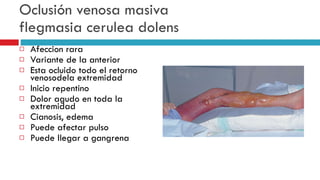 Oclusi ó n venosa masiva flegmasia cerulea dolens Afeccion rara Variante de la anterior Esta ocluido todo el retorno venosodela extremidad Inicio repentino Dolor agudo en toda la extremidad Cianosis, edema Puede afectar pulso  Puede llegar a gangrena 