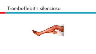 Tromboflebitis silenciosa 
