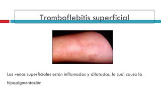 Las venas superficiales están inflamadas y dilatadas, lo cual causa la hipopigmentaci ó n   Tromboflebitis superficial 