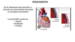 PERICARDITIS
Es la inflamación del pericardio, a
menudo con acumulación de líquido
en el espacio pericárdico
La pericarditis puede ser
• Aguda
• Subaguda
• Crónica
 